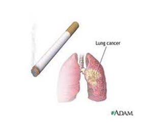 Κάπνισμα και Καρκίνος του Πνεύμονα