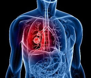Συμπτώματα στον καρκίνο του πνεύμονα